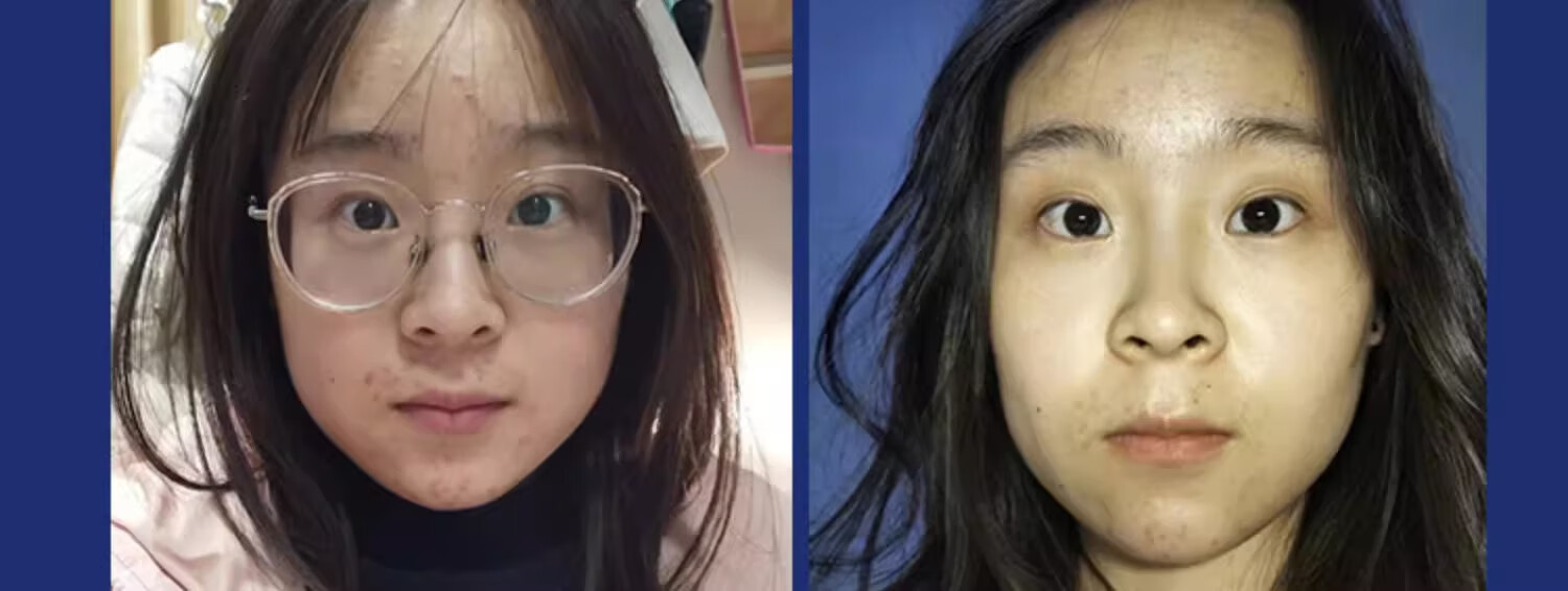NHFOUYOU祛痘精华液祛痘膏去闭口粉刺痘坑痘印淡化消印收缩毛孔精华液 一瓶【30ml】建议按疗程使用