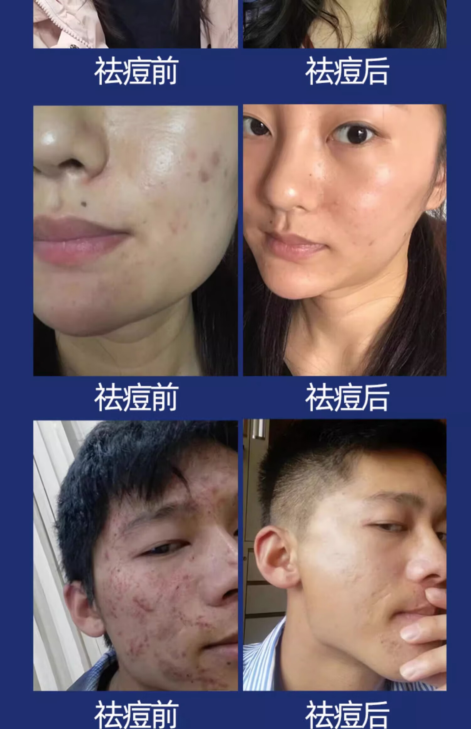 NHFOUYOU祛痘精华液祛痘膏去闭口粉刺痘坑痘印淡化消印收缩毛孔精华液 一瓶【30ml】建议按疗程使用