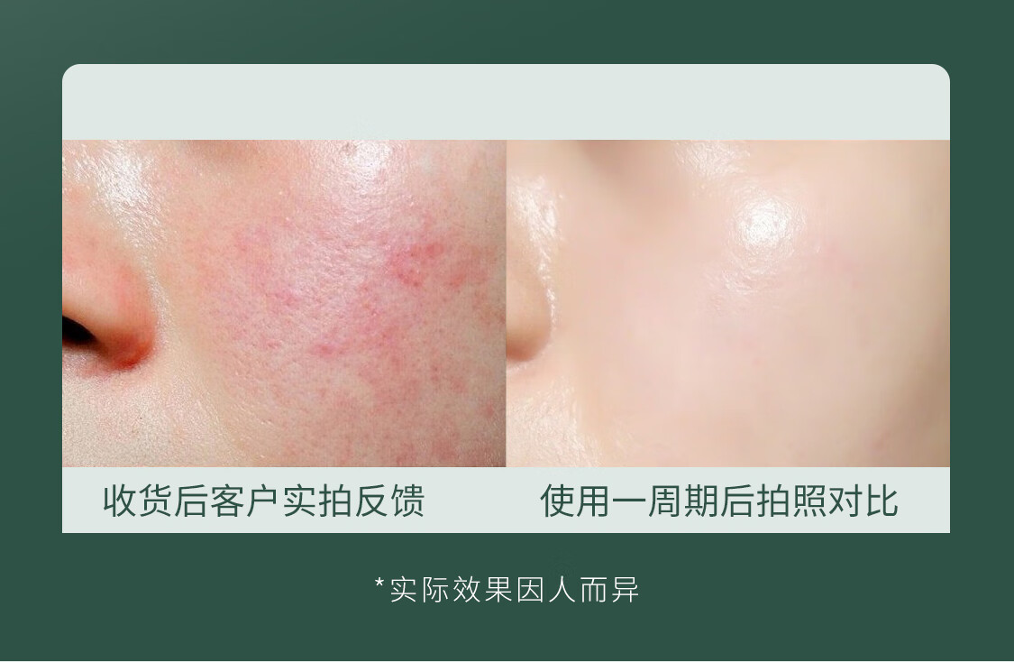 MDB 多酸去黑头小气泡清洁泡泡面膜积雪草水杨酸自发泡收敛毛孔男女 200g【2只优惠装】