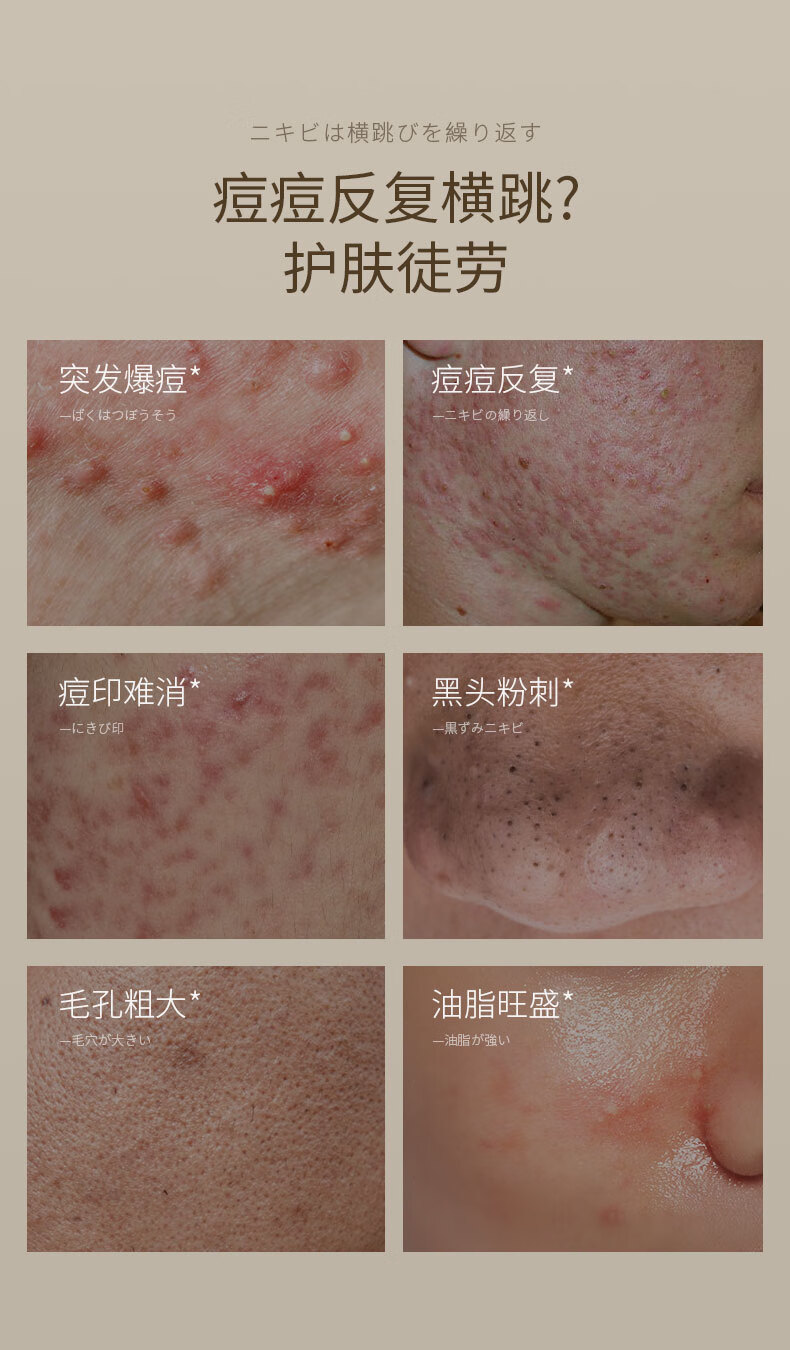 SUMDOY日本进口壬二酸祛痘印痘坑修复膏去痘红肿淡化痘印痘疤女男士 祛痘抑痘30g