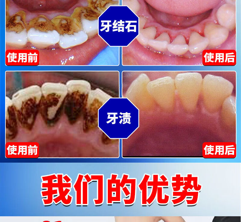 【牙齿结石喷剂】牙结石牙垢口i臭烟渍牙渍牙斑牙齿美i白结石去除器