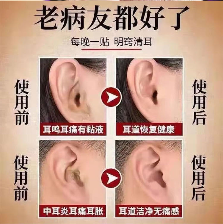 【耳鸣特效贴】耳鸣贴耳聋耳鸣神经性听力下降耳朵嗡嗡响特效贴 一