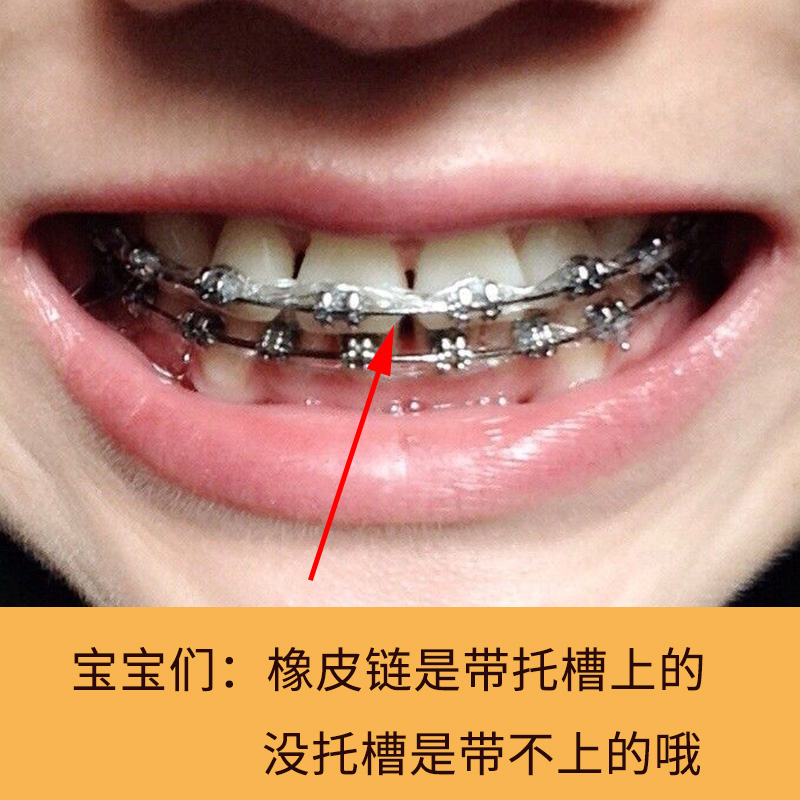 牙科正畸橡皮圈牙套橡皮筋牙齿弹性橡皮链口腔材料拉力牵引圈 安装