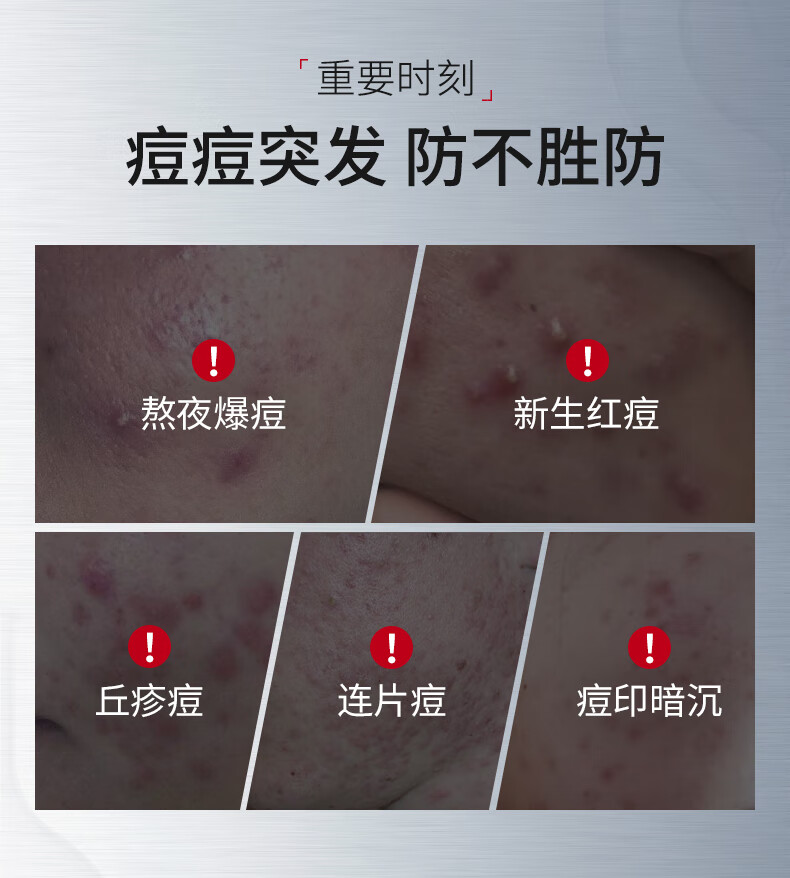 ning新加坡进口祛痘印修复淡化痘印痘坑收缩毛孔修复芦荟凝胶护肤品 【养成无痘肌】祛痘凝露50g*2支