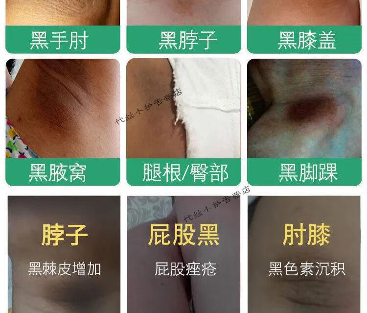 柏俞腚百草之堂草本乳膏 脖子黑棘皮症 腋窝黑色素屁股沟发黑 1盒