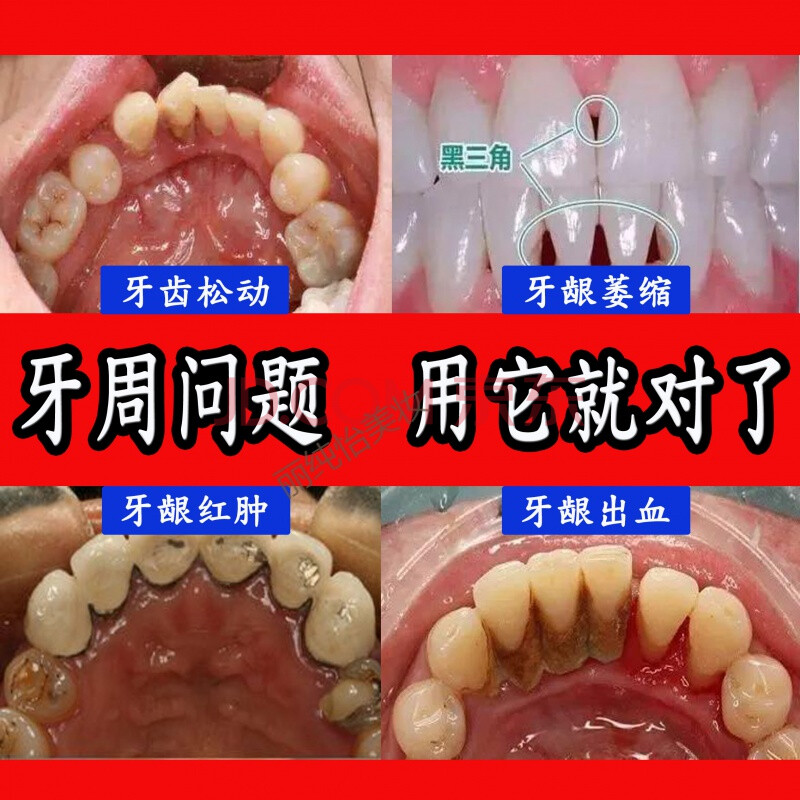 修复蛀牙牙龈萎缩修复再生牙粉蛀牙宣散牙膏牙洞松动红