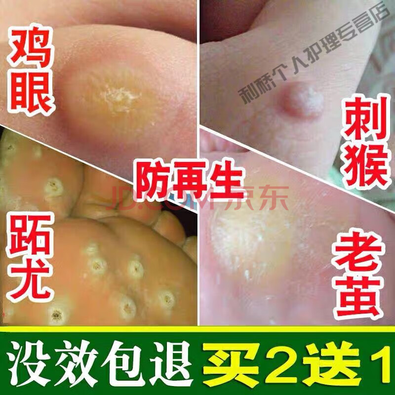 去脸面部扁平i尤祛i颈脖子丝状疣尤腋下肉i粒刺瘊子私i处疣克疣液约膏