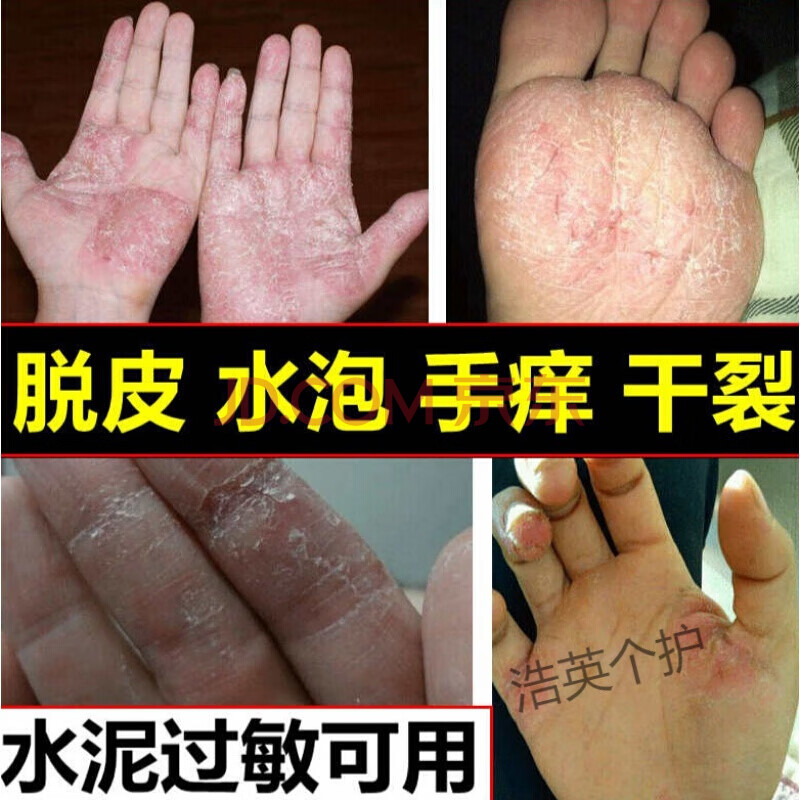 手痒脱皮水泡掌心干裂水泥过敏手指头烂瘙痒手藓手气止痒膏反复