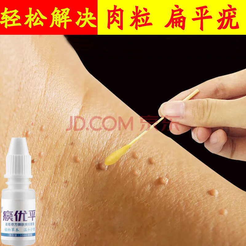 苗凤凰疣瘊平扁平i疣脸部疣必治除疣疣立净去猴子肉粒鸡眼去刺猴丝状