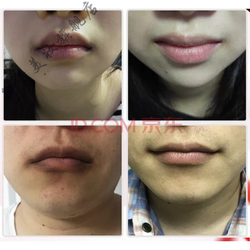 黑洗不干净力美吉唇周暗沉嘴唇边黑周围嘴角旁发黑黑色素非神器非去除