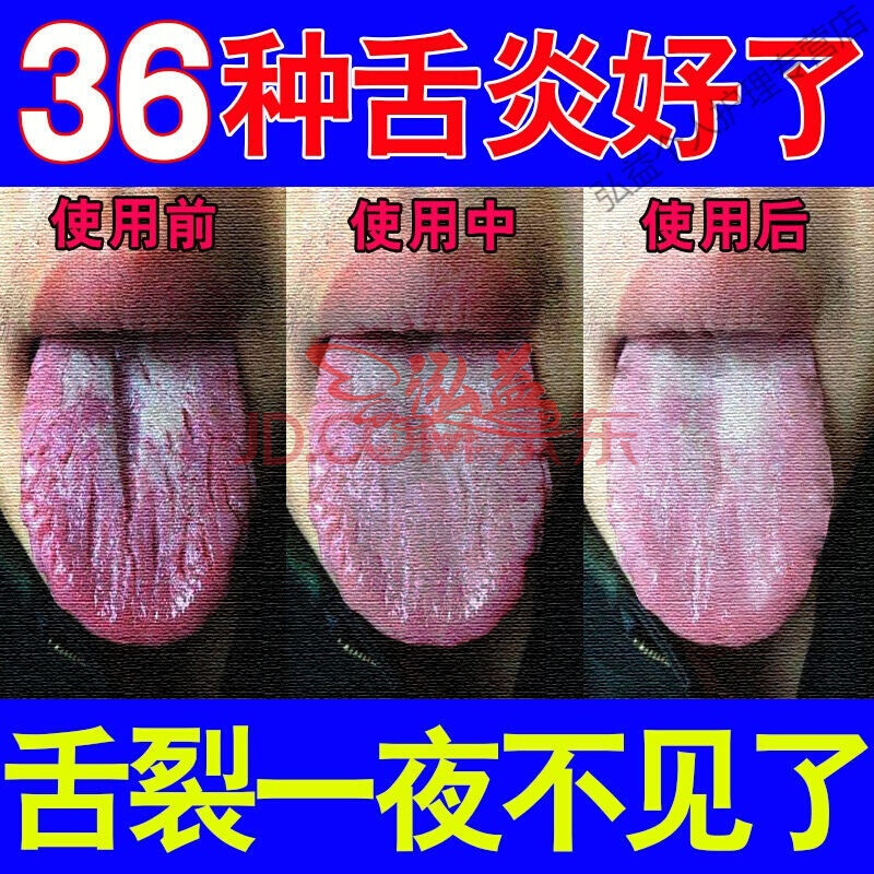 【舌裂一夜不见】专治36种舌炎疼痛烂舌头舌乳头炎舌干裂口干肿胀
