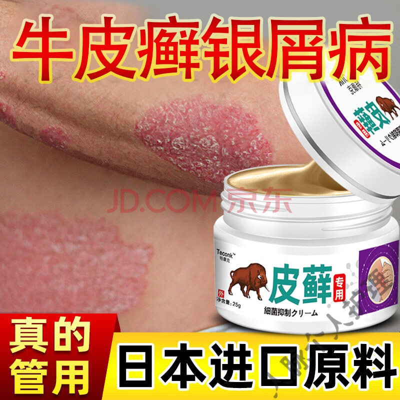 牛皮l癣约膏专用进口银l屑病顽固性手足头皮l癣体股l藓湿l疹止瘙痒