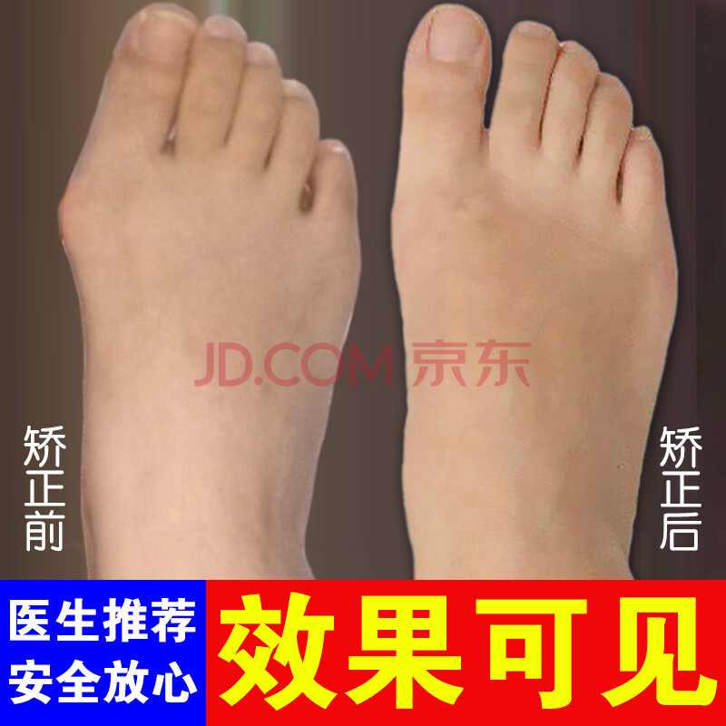 脚拇指外翻矫正器男女士儿童大脚骨脚趾倾斜外翻纠正夜用 一代(左右一