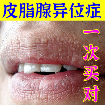 皮脂腺异位嘴唇干裂起泡长白斑丘l疹疙瘩润唇膏唇部长脂肪粒小白点