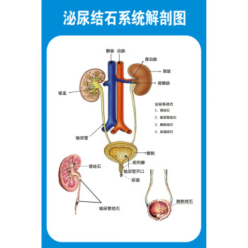 肾结石泌尿结石解剖图医学宣传挂图人体器官结构图医院海报墙贴纸泌尿