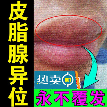 治l疗皮脂腺异位嘴唇异位症增生白点干裂脱皮红肿上火起泡专用箹l膏一