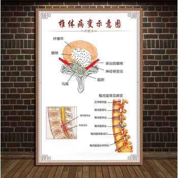 人体椎间盘常见病变颈椎脊椎息图骨骼挂图医院腰椎间盘突出墙贴 椎体