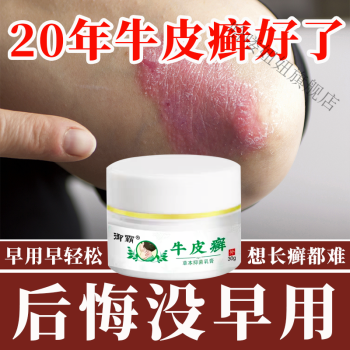 治牛l皮l癣银i屑皮肤顽癣止瘙痒偏方湿l疹手足皮肤l癣皮l炎专用l箹l膏