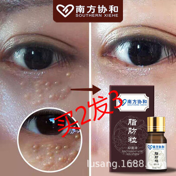 南方协和草本祛眼部脂肪粒去除油脂粒汗管瘤眼霜膏黑眼圈袋眼部细