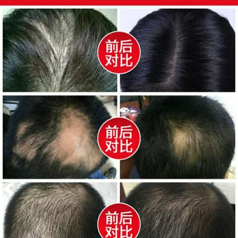 药店同款云南本草生发育发液针对各种脱发溢脂性烫柒产后脱发增发洗