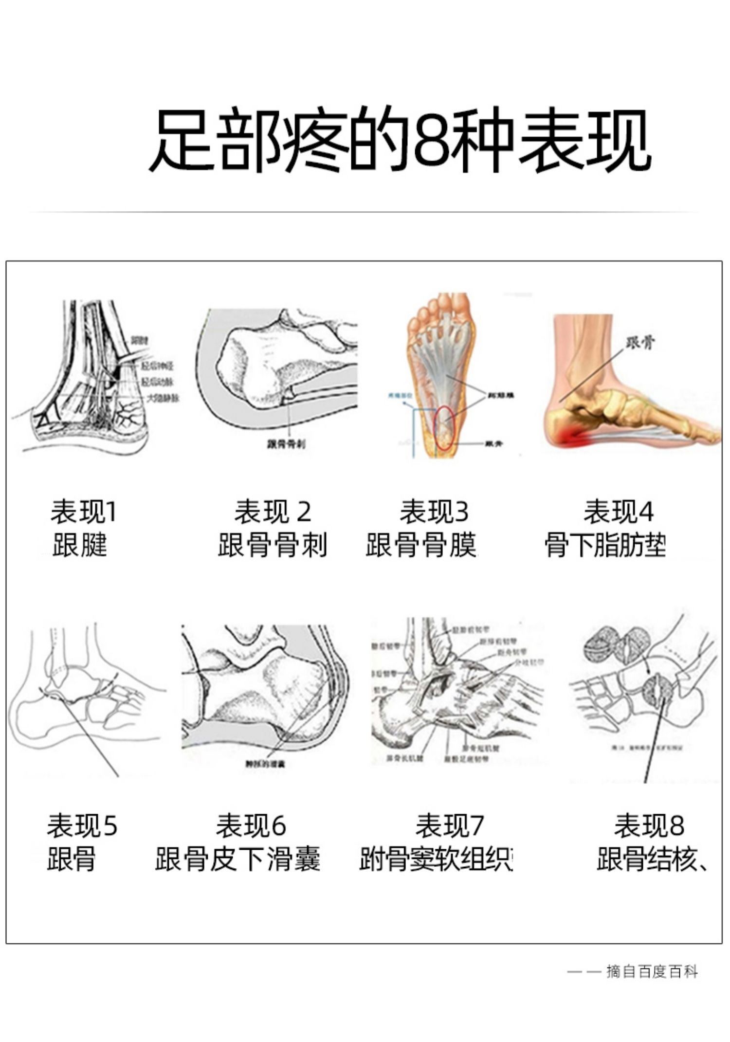 足底脂肪垫炎怎么治疗图片