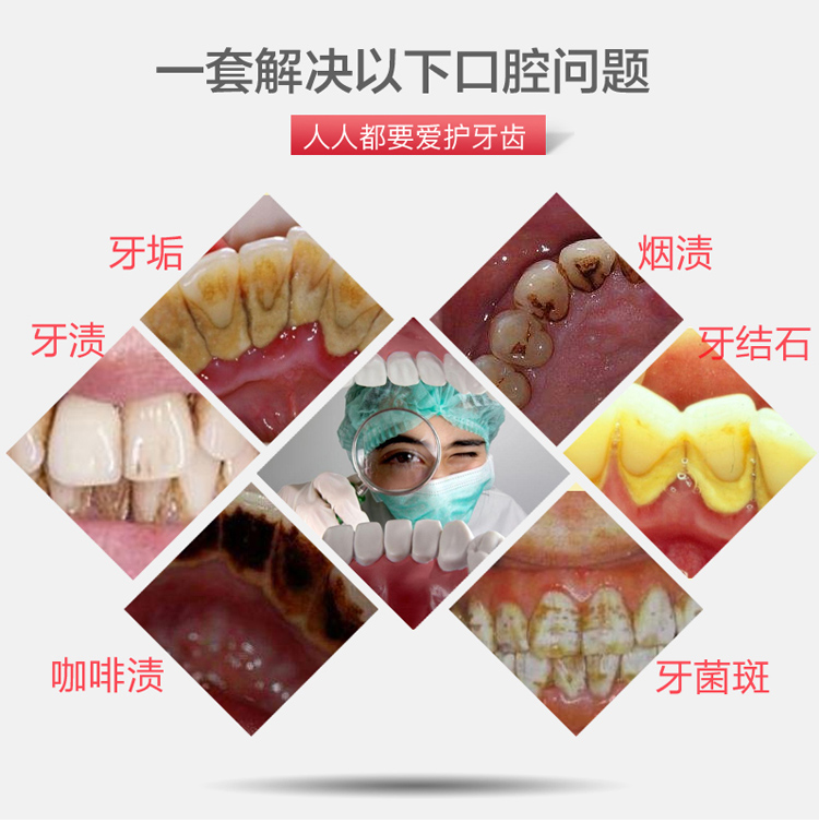 牙结石清洁工具牙结石去除器牙医口腔工具材料神器镜子剔去牙垢牙齿