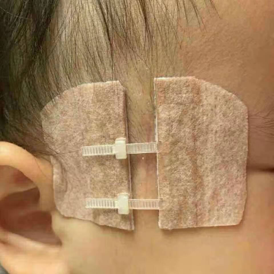 皮肤减张器皮肤表面缝合器立辰减张器皮肤吻合器术后护理155厘米10格