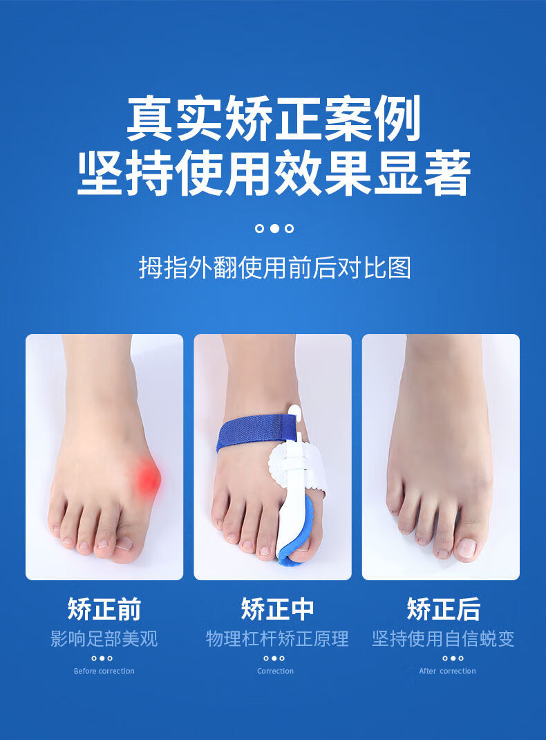 拇外翻矫正器大脚骨脚指头脚趾大拇指分趾分离器男女日夜装加强型夜用