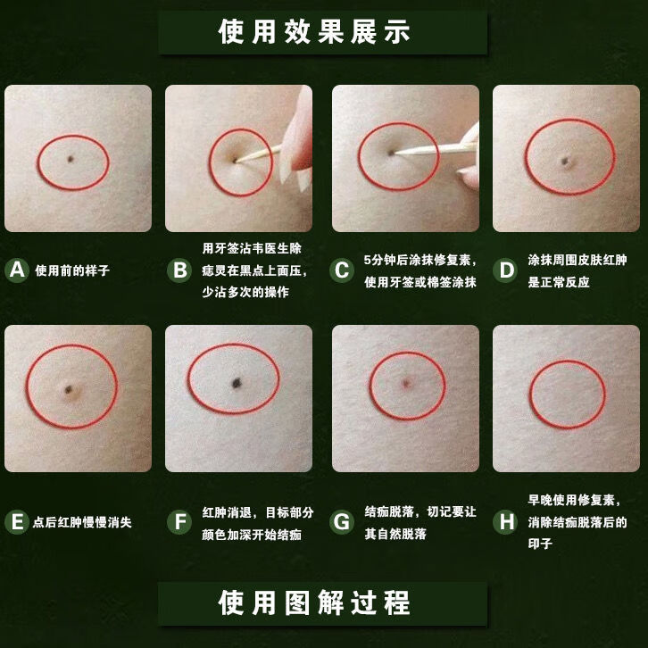 去痣祛痣点痣祛班水笔贴脸部无痕灵修复液水取痣除痣一套