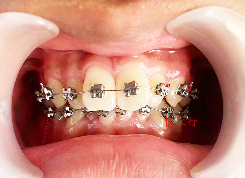 自锁托槽 牙科金属自锁正畸托槽5代6代金属自锁托槽有 6代自锁托槽 送