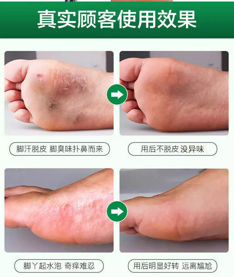 去掉脚臭治疗脚痒苗家本草鞋臭鞋子喷剂脚臭克星去烂脚丫脱皮水泡乳膏