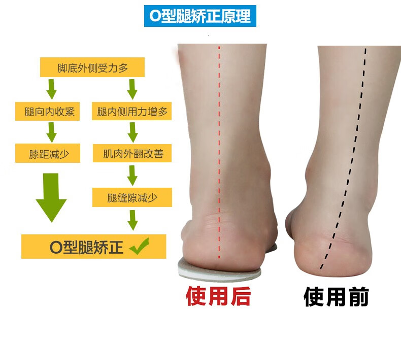 o型腿型矫正外八字脚偏矫正器脚跟足内翻磨鞋底o形腿外高内低鞋垫爱护