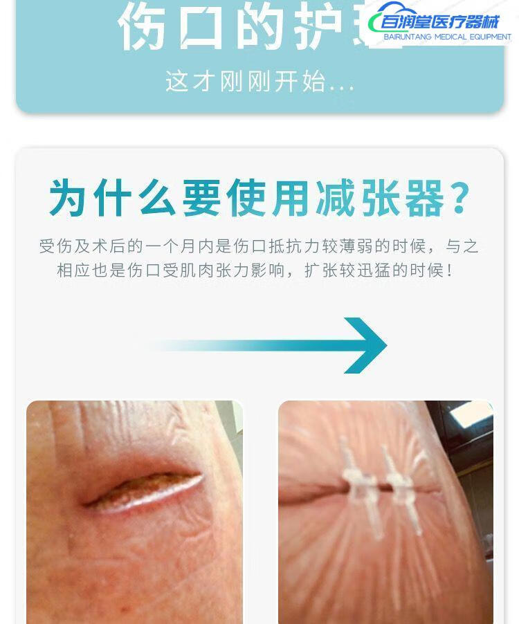 减张器剖腹产伤口愈合贴刀口贴疤痕增生伤口缝合贴皮肤缝合器加长版