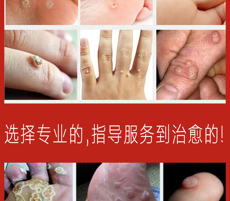 跖疣膏修脚店专用手足部肉刺猴子趾疣老茧无痛膏贴疣瘊净 白色【图片