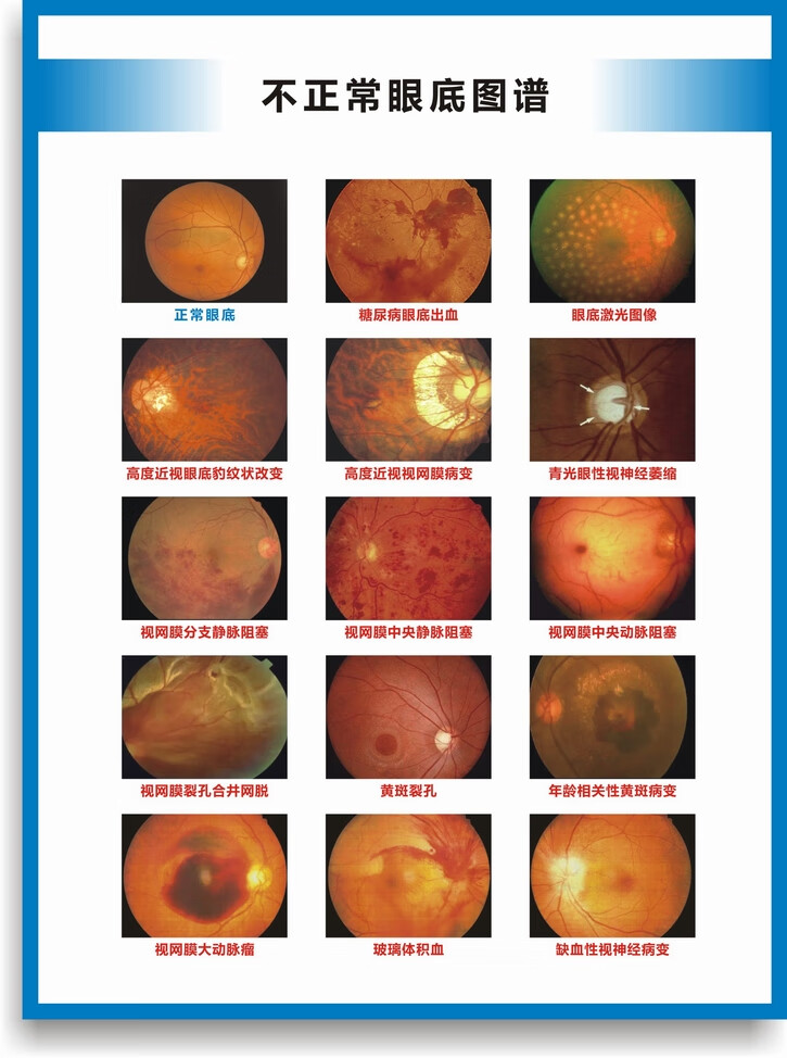 眼球解剖图结构图眼球的构造眼睛穴位按摩眼保健操眼科海报挂图 眼底