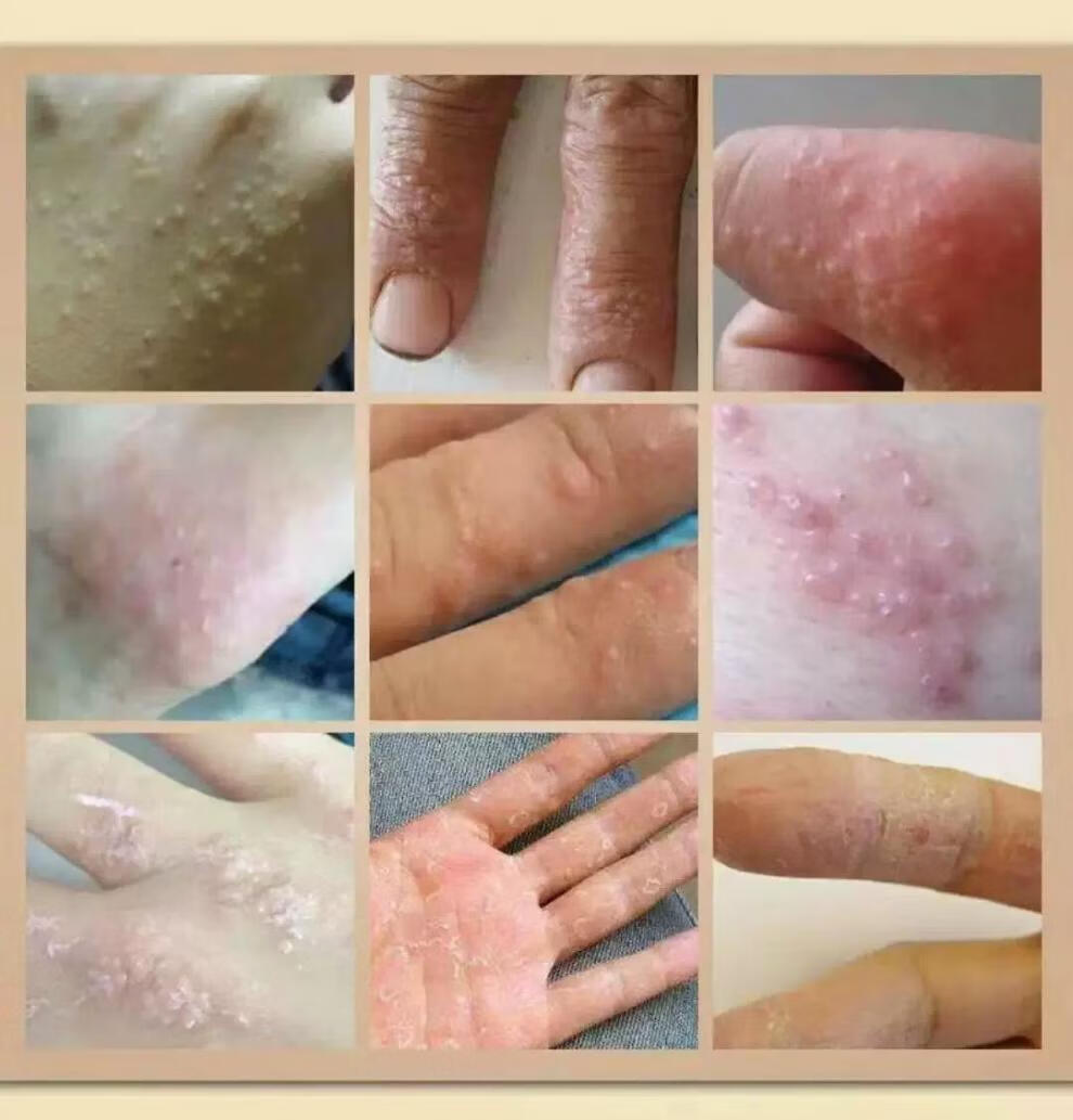 治疹膏皮肤瘙痒去手根手上长水泡手脱皮止痒膏单瓶装30g