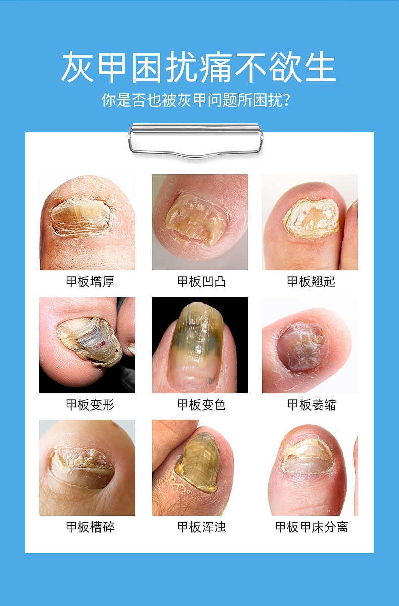 冰王乐施液体伤口敷料 灰甲止修护型 去除灰指甲脱甲生长液 30ml