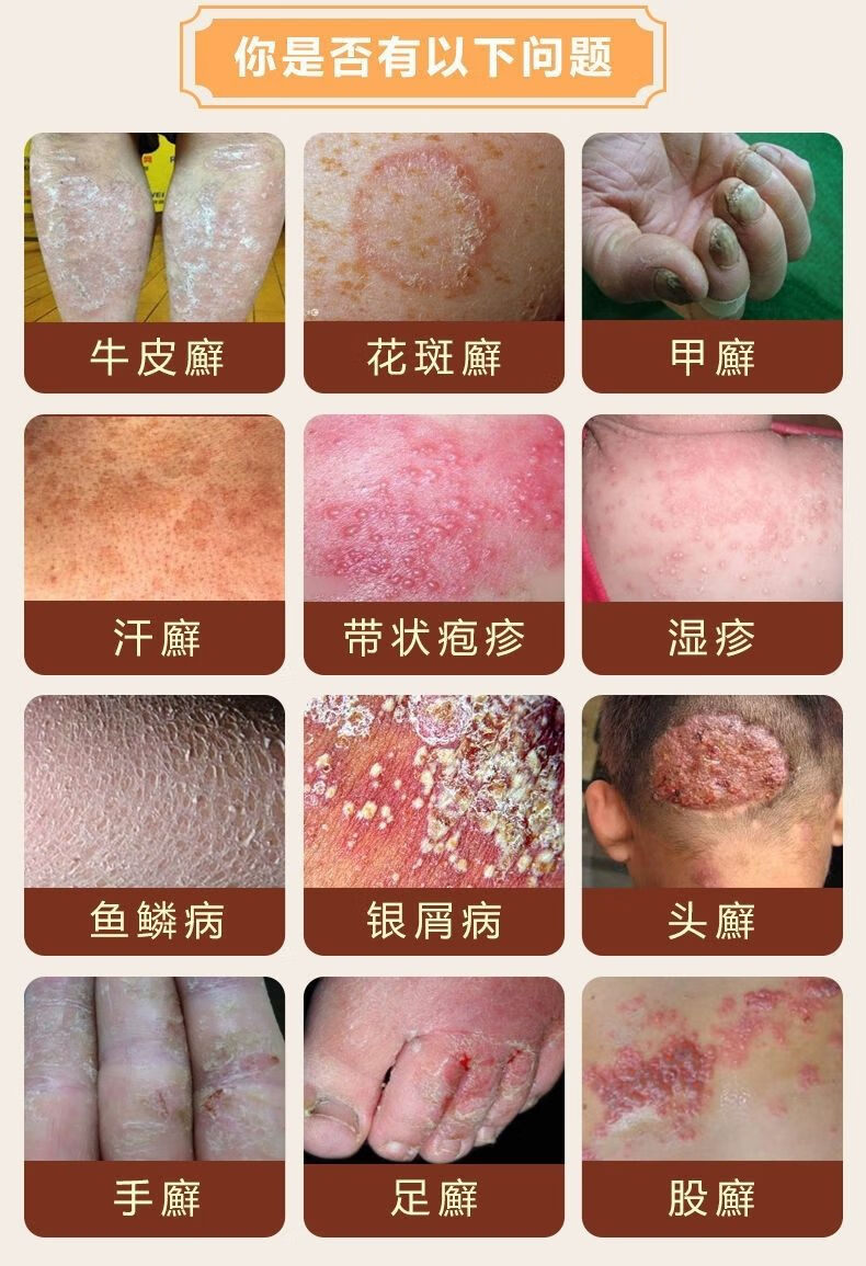 艾夫特百草膏芙贝乐百草肤清霜湿iii疹皮iii炎牛ii皮i荨i麻i疹大腿