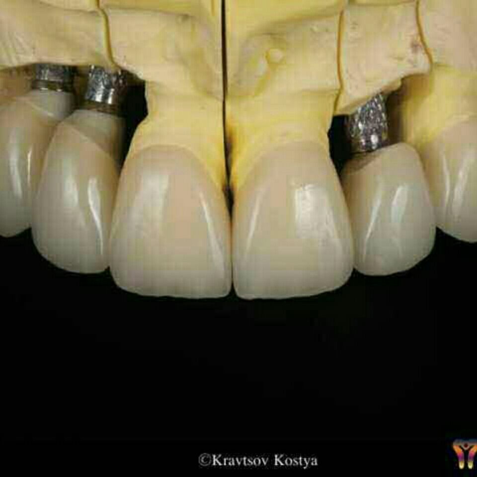 自己粘烤瓷牙胶水自己粘牙齿的专用胶水粘牙胶粘接剂牙套牙冠胶水普通