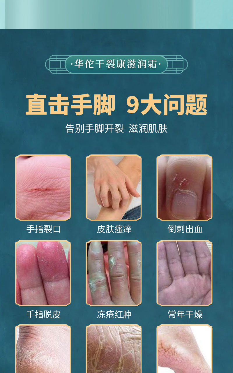 乾裂康手腳乾燥開裂魚鱗蛇皮幹癢凍i瘡滋潤霜老年人成人兒童腳後跟