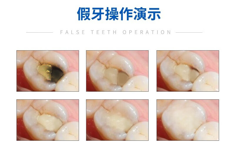 京选品质粘牙专用胶假牙胶水自己动手粘烤瓷牙胶水固定牙套牙冠全瓷