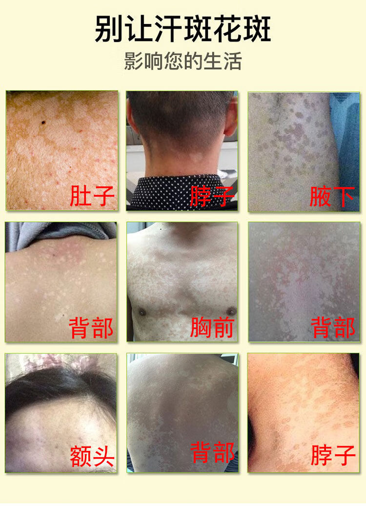 汗i斑膏汗i斑净白斑花i斑褐色去汗i斑露红白色胸前背部汗i斑花软膏斑i