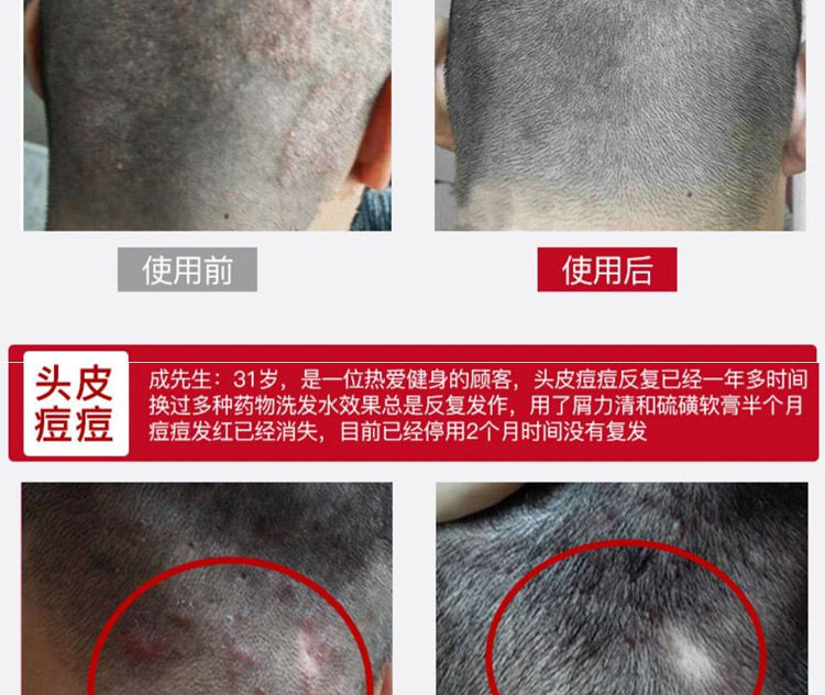 头皮毛囊焱炎脂溢性皮ii炎洗发水去屑止痒控油头皮养护痛脓包疙瘩扣