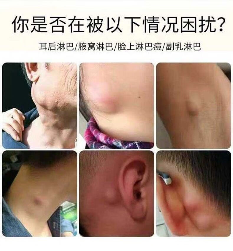 副乳消除神器淋巴結腫大炎消貼頸部耳後腋下副乳消除神器硬塊淋巴結節