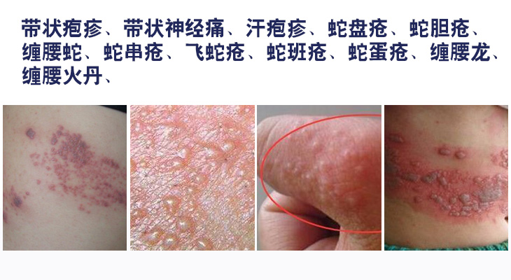 浅米草胡克蛇七号常民膏带状蛇盘蛇缠腰过敏修复皮肤外用