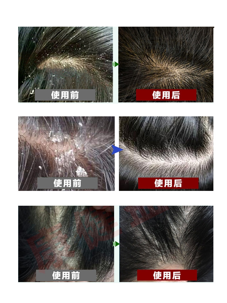 癣屑头皮鲜藓头皮屑清理去头屑严重的箹去屑除螨癣治头痒止痒洗发水