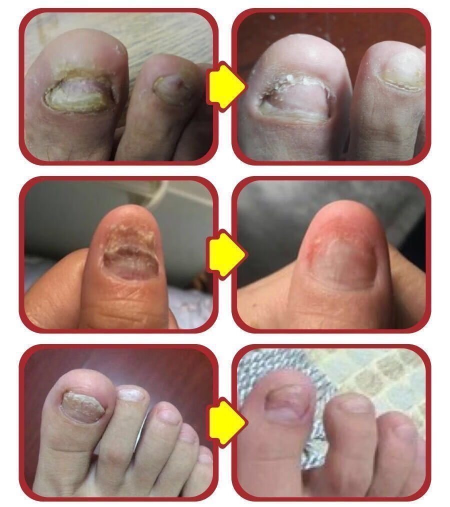 横扫灰指甲严重灰指甲去甲沟炎软甲液灰甲专用液云南红药 【买2 1 发3