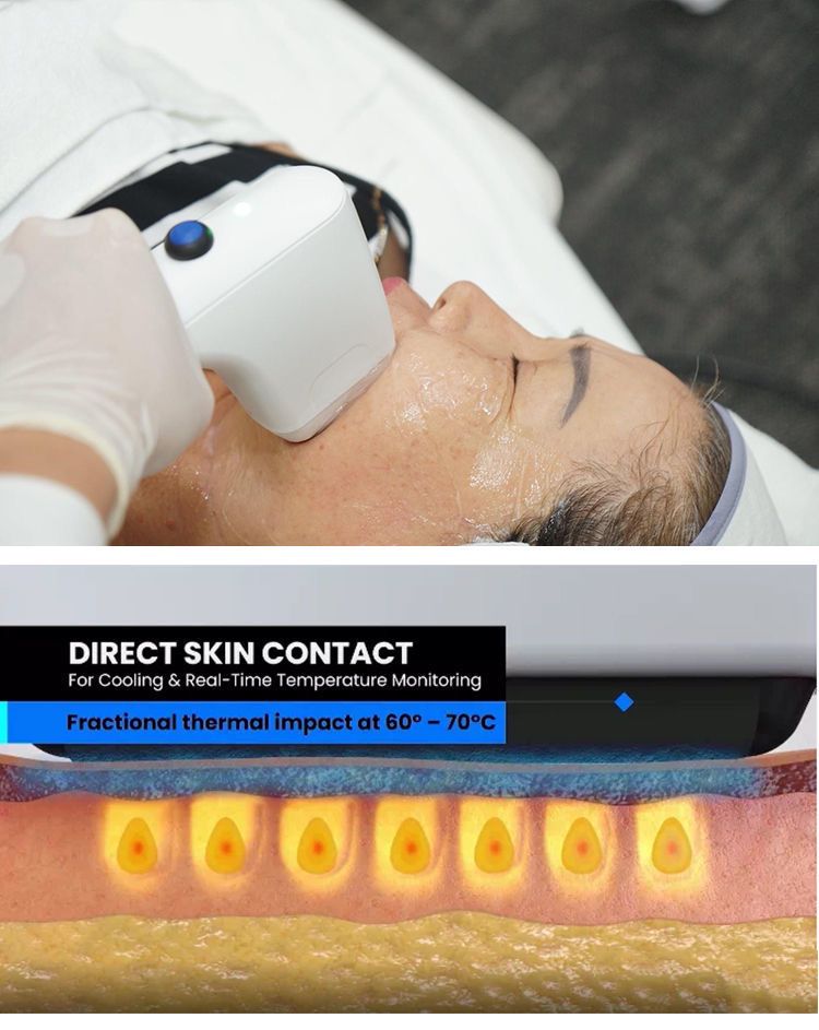 以色列技术sofwave索芙波美容仪器美容院专用提拉紧致索夫波仪器中松