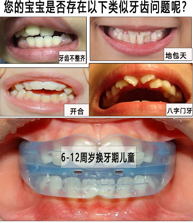 牙套兒童牙齒器兒童夜間門牙突出齙牙糾正器小孩地包天牙套盒子(口腔