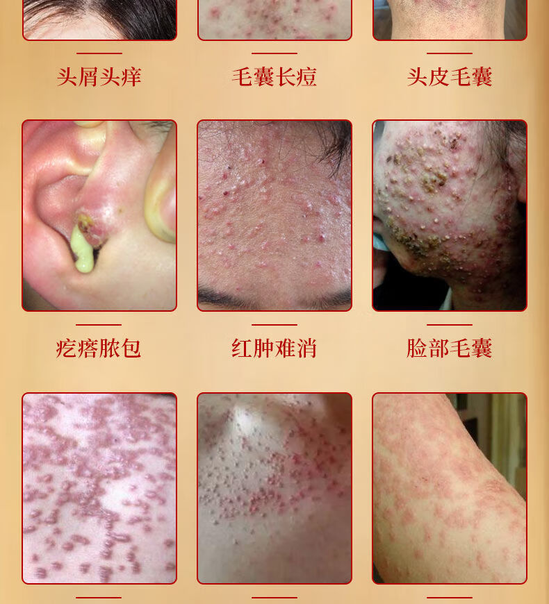 头皮毛囊炎毛囊炎膏治头部脸部背部胸部毛囊炎痘痘脓包痤ii疮皮肤瘙痒